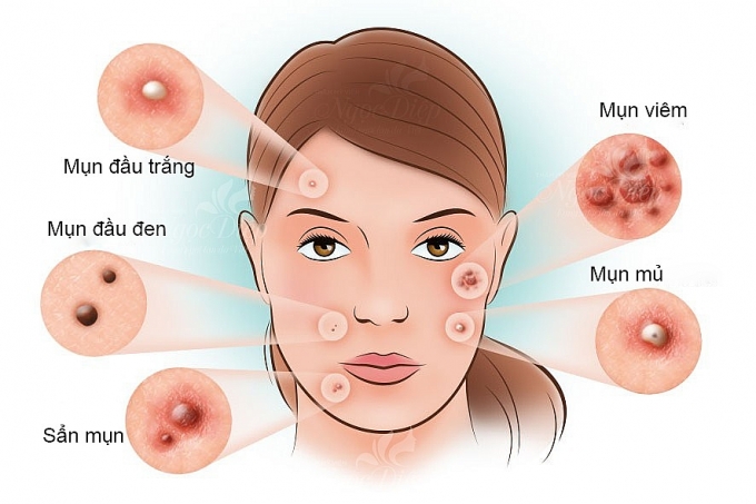 4 cách trị mụn an toàn và hiệu quả giúp làn da trắng hồng 4 cach tri mun an toan va hieu qua giup lan da trang hong