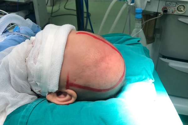 Bé trai Phú Thọ được chẩn đoán mắc dị tật hộp sọ hiếm gặp